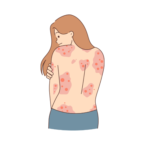Eczema